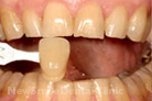 Case 6 - Before Treatment